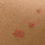 Bed bug bites on human skin.