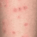 Beetle bites on human skin.