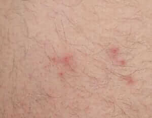 Flea bite on human skin