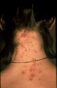 Lice bites on human neck.