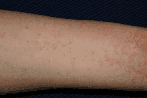 Scabies on human arm.