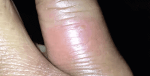 Spider bite on finger.