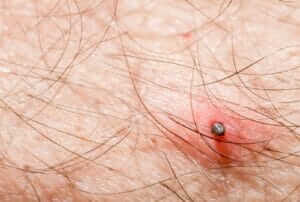 Tick bite on human skin.